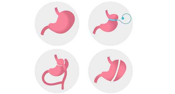 Bariatric Surgery