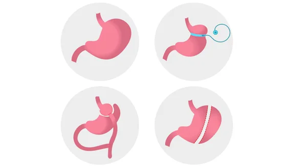 Bariatric Surgery