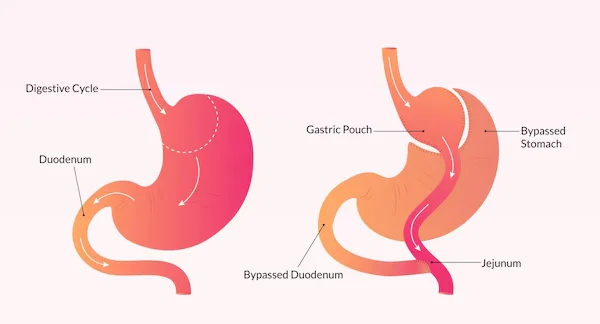 Gastric Bypass Surgery