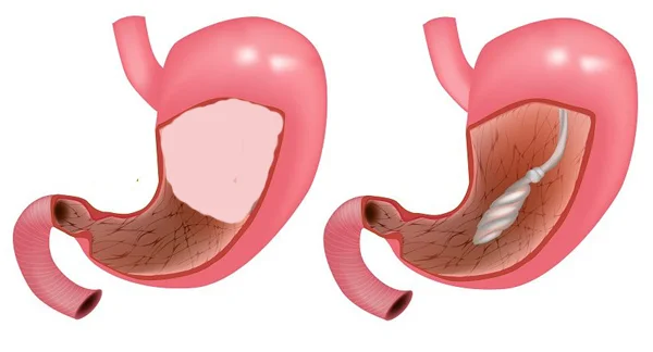 Swallowable Gastric Pill Balloon for Weight Loss