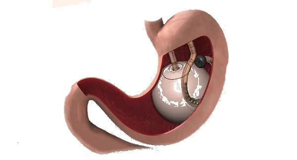 Weight Loss Surgery
