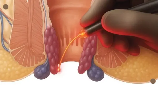 Laser Treatment for Piles