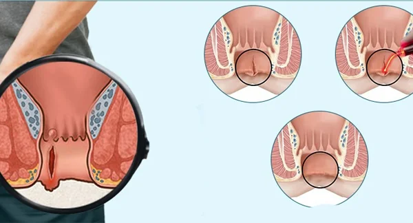 Fissure Laser Surgery