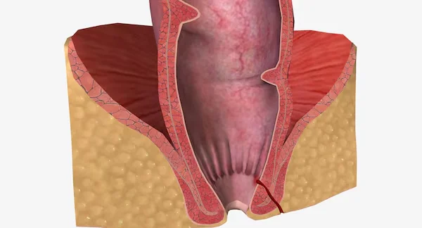 Laser Surgery for Fistula