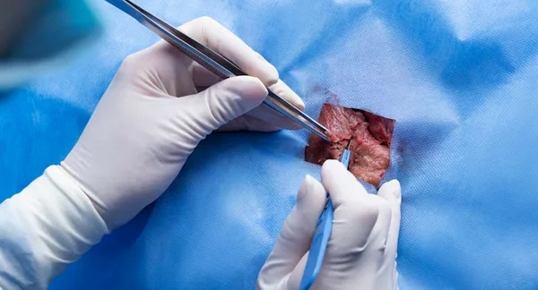 Incision and Drainage