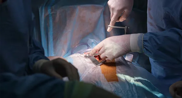 Open Cholecystectomy