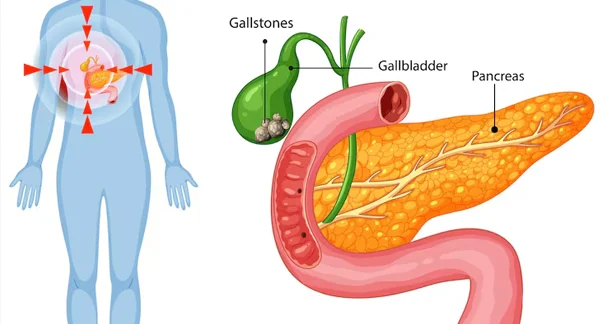 Laparoscopic Cholecystectomy