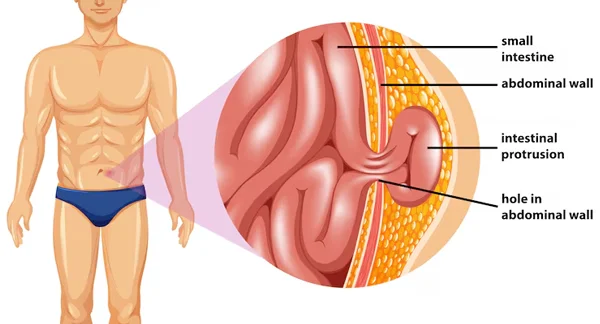 Inguinal Hernia Surgery