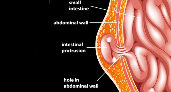 Laparoscopic Hiatal Hernia Repair