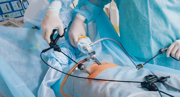 Laparoscopy