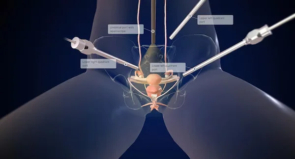 Hysterectomy