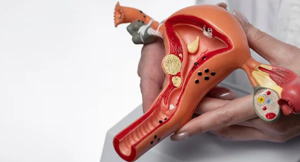 Laparoscopic Hysterectomy