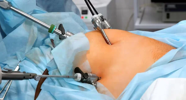 Laparoscopic Fibroid Removal