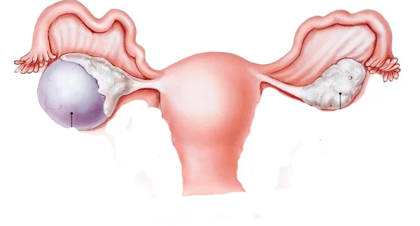 Lap Cystectomy Preserve Ovary Function