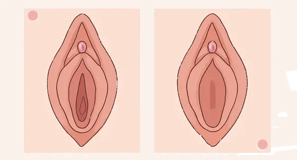 Hymenoplasty Surgery