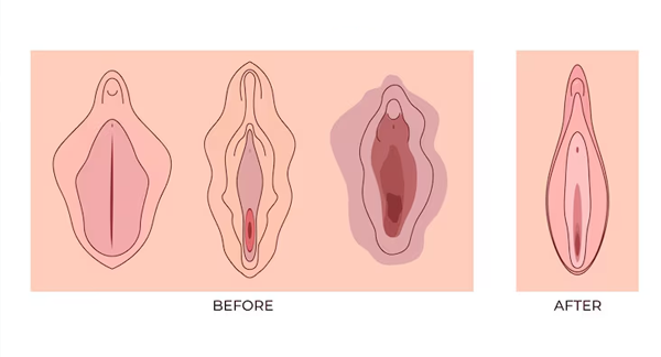 Labiaplasty Procedure