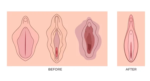 Gynaecology
