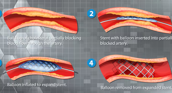 Coronary Angioplasty