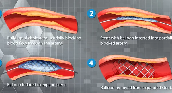 Coronary Angioplasty