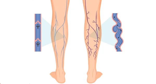 Sclerotherapy