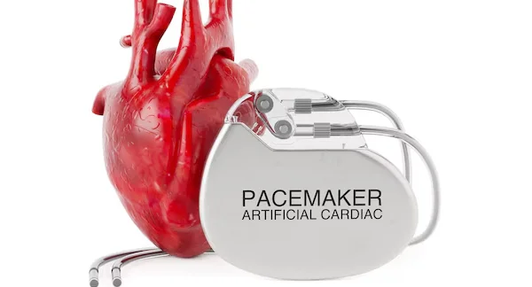 Pacemaker Implantation Surgery