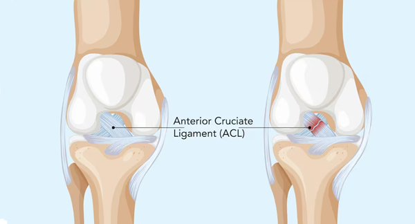ACL Reconstruction Surgery