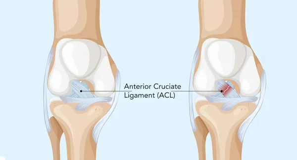 ACL Reconstruction Surgery