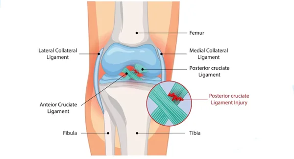 PCL Reconstruction Surgery