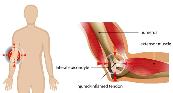 Tennis Elbow Release Surgery