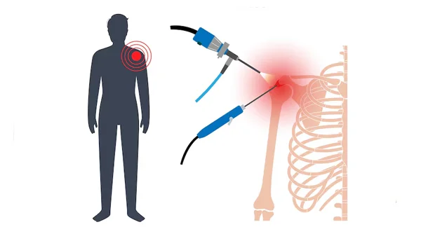 Shoulder Arthroscopy