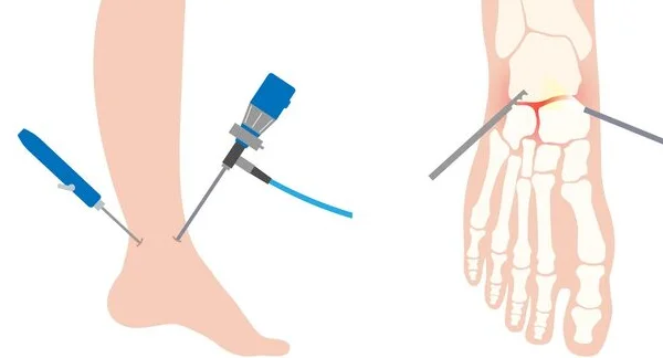 Ankle Arthroscopy