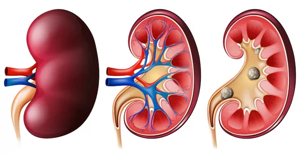 PCNL Surgery