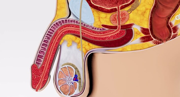 Varicocelectomy
