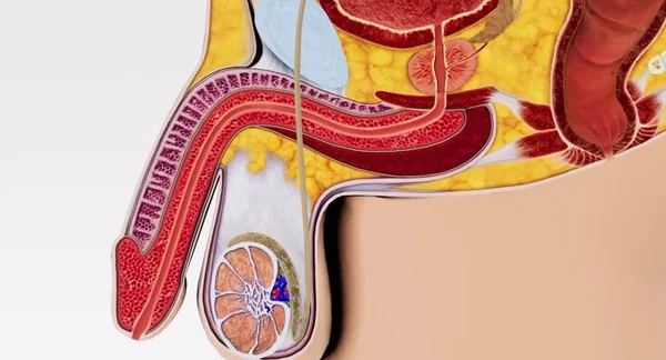 Varicocelectomy
