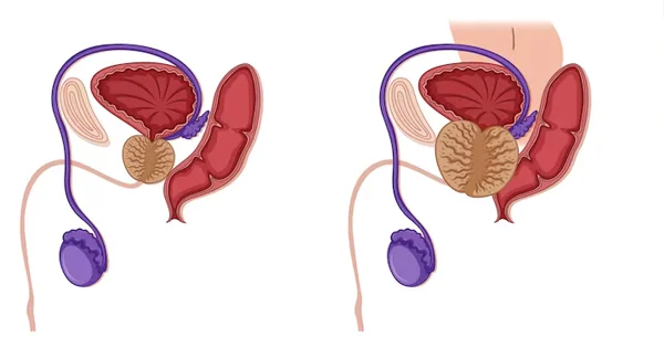 Transurethral Resection of the Prostate