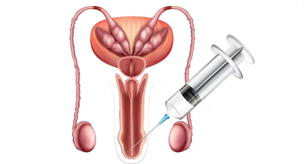 Penile Implant Surgery