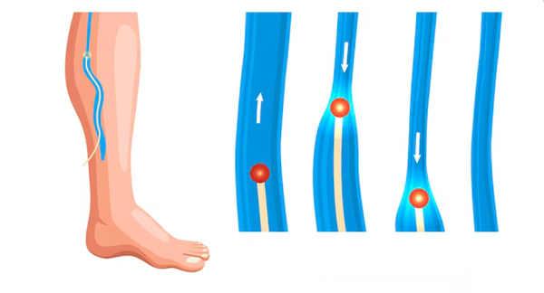Laser Treatment for Varicose Veins