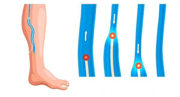 Laser Treatment for Varicose Veins