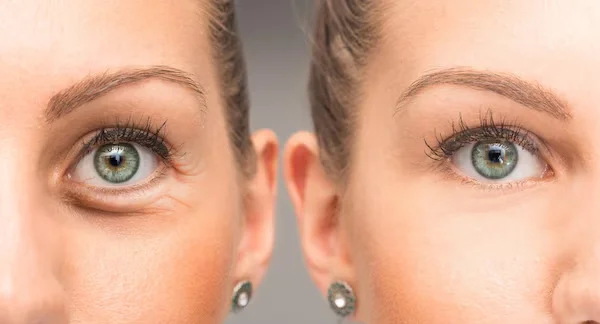 Blepharoplasty
