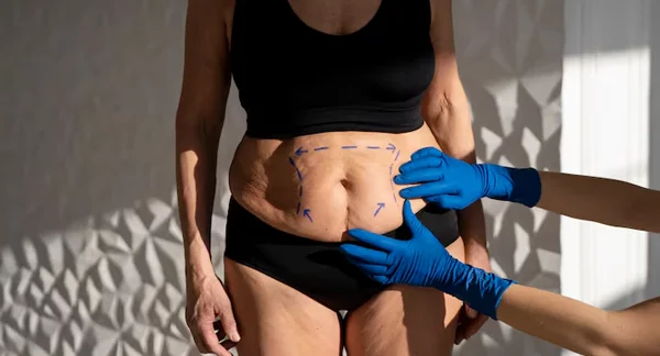 Tummy Tuck Abdominoplasty