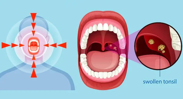 Tonsillectomy Tonsil Surgery