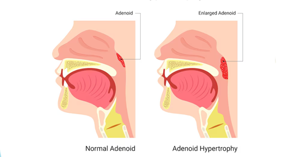 Adenoidectomy Adenoid Removal