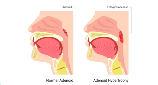 Adenoidectomy Adenoid Removal