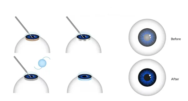 Cataract Surgery