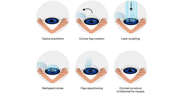 Lasik Eye Surgery