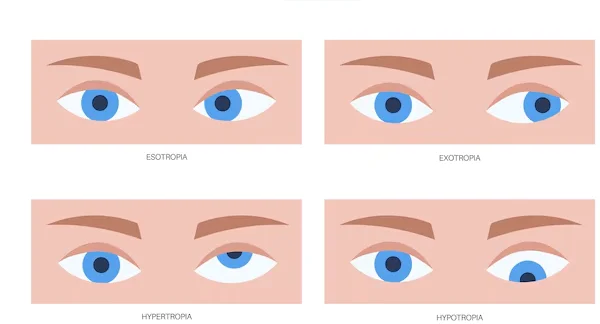 Squint Surgery Strabismus