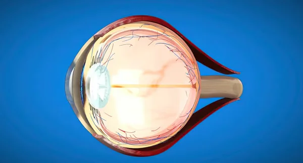 Cornea Transplant